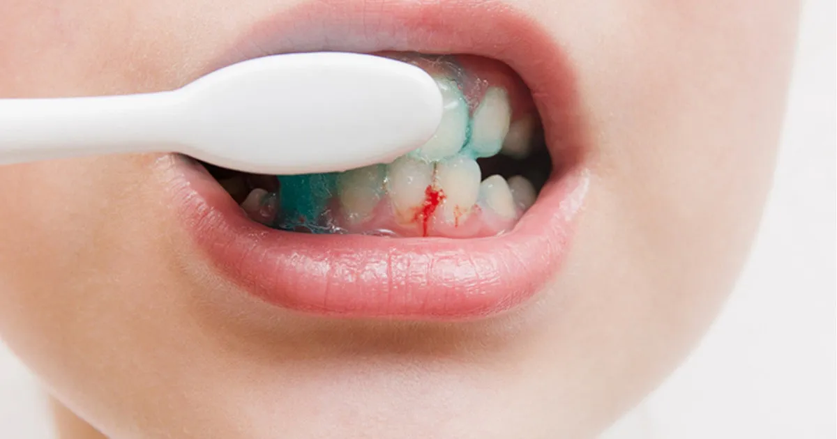 Hoe Bloedend Tandvlees Migraine kan Veroorzaken